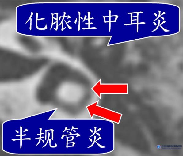 感冒后头晕目眩可能是这种疾病　台湾晕眩权威：止晕止吐药物只能治标